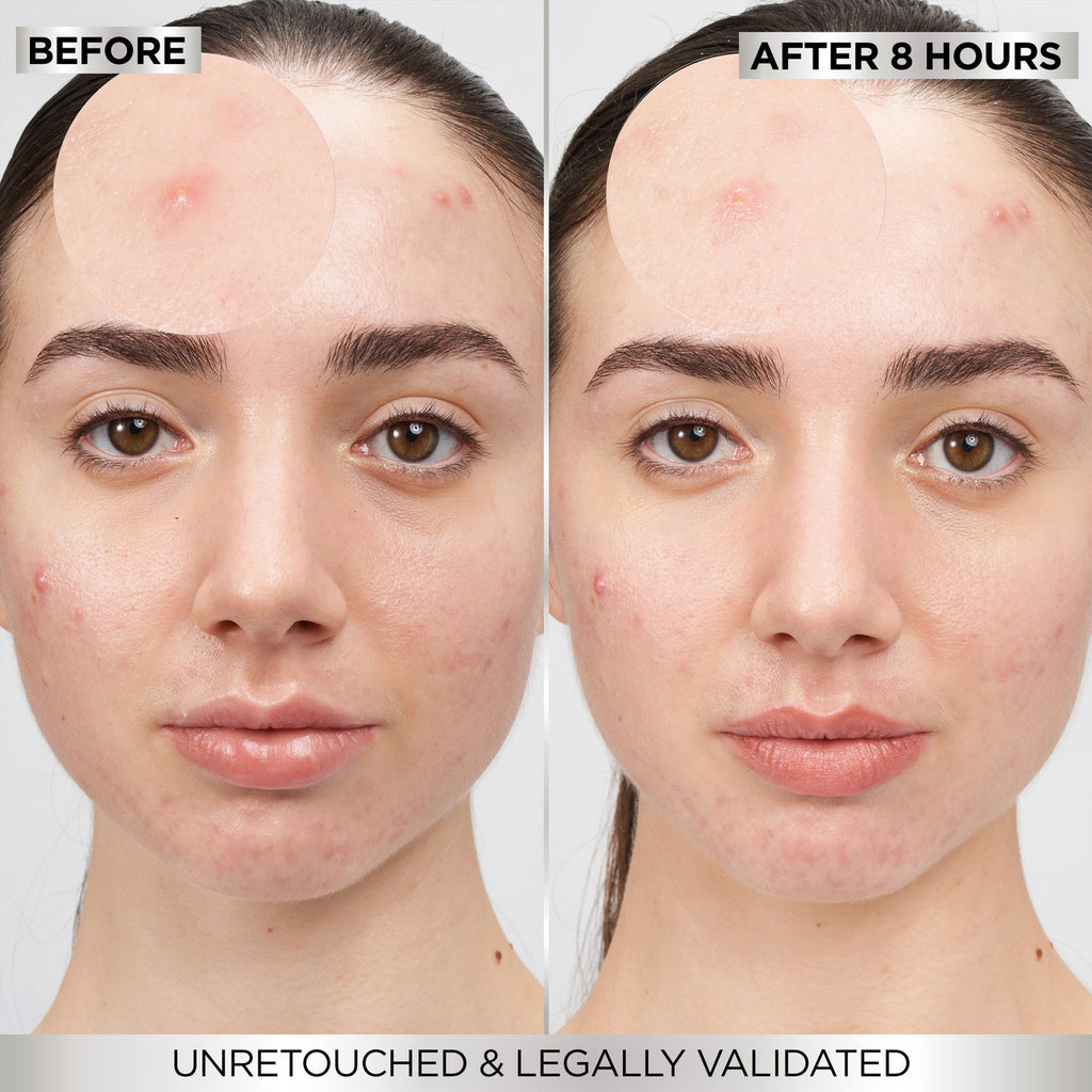 Garnier Pure Active 8hr Pimple Patch 22pk